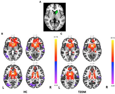 Abnormal functional connectivity of the frontostriatal circuits in type 2 diabetes mellitus